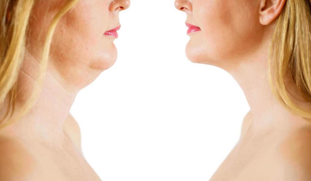 Double Chin treatment Bexley before and after results