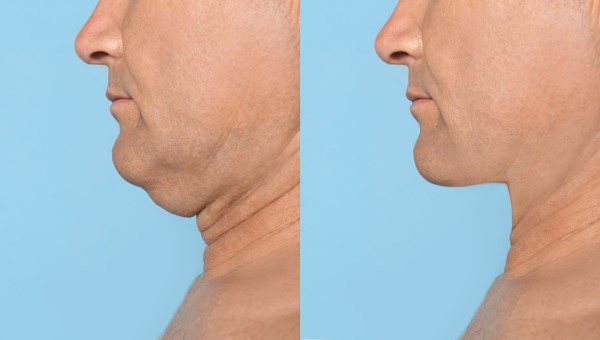 Which Non-Surgical Treatments Work Best for Jowls and Loose Skin Bexley?