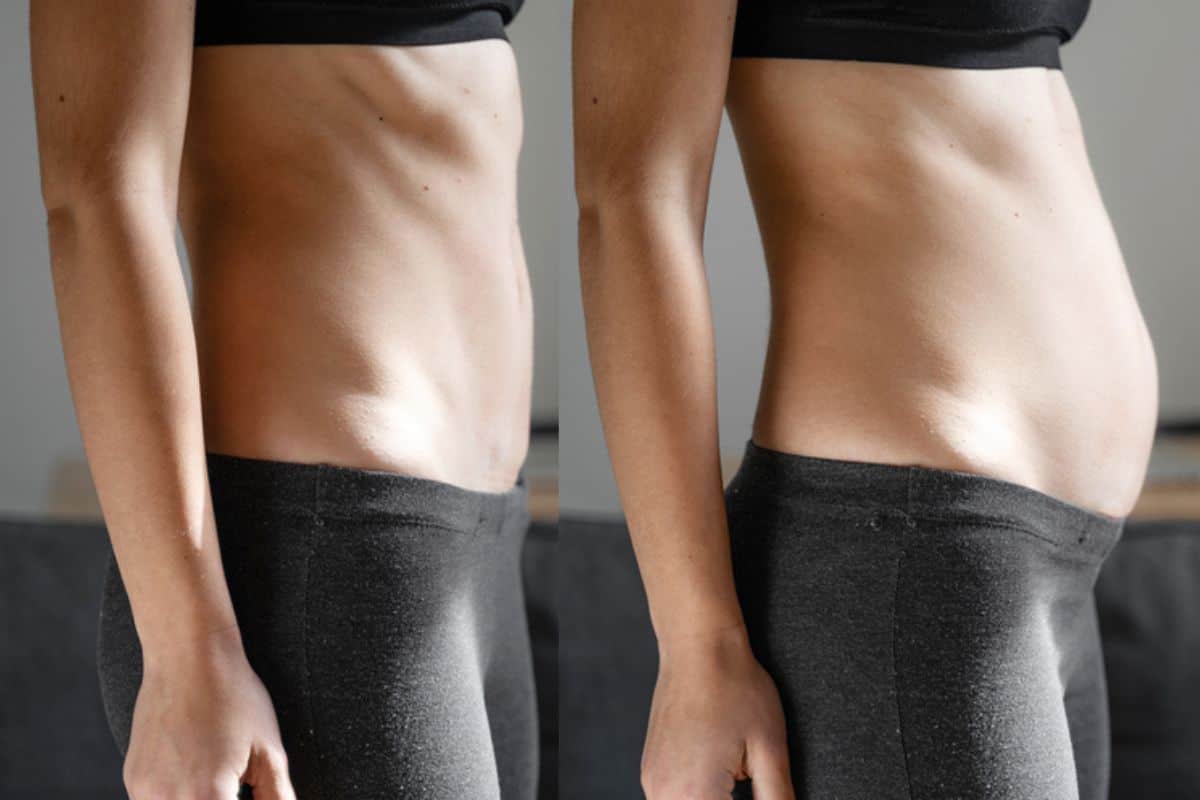 How long does diastasis recti take to improve Bexley?