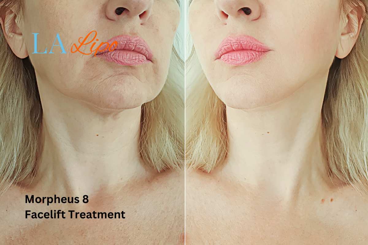 Turn back time with Morpheus8 Treatment Bexley