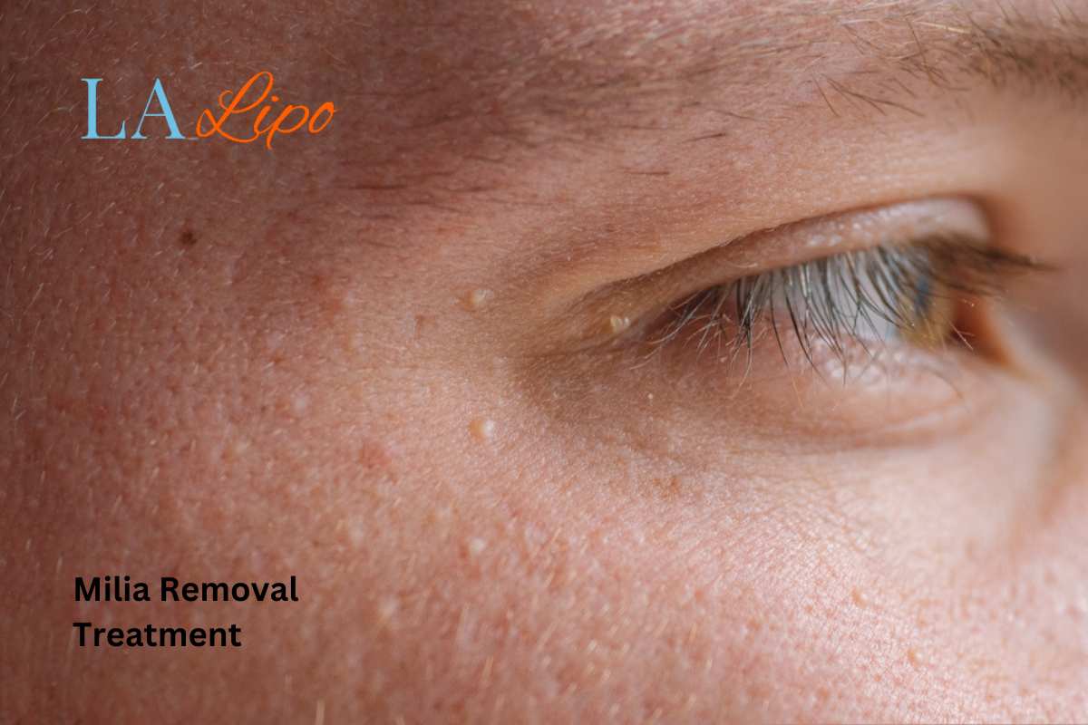 Cryopen Milia Removal: Is It the Easiest and Safest Option Bexley?
