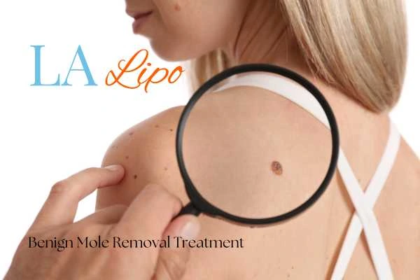 Woman having her inspection of blemish before mole removal Bexley