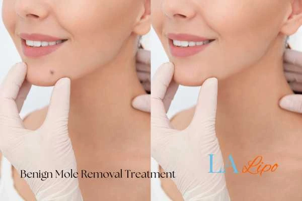 Before and after mole removal Bexley treatment
