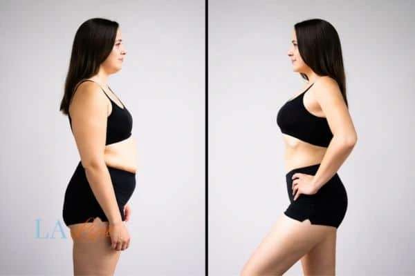 LA-EMS Body Sculpting Bexley results before and after of womans results on body toning.