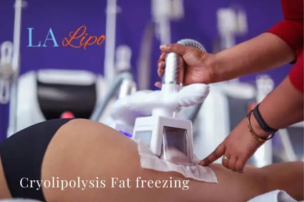 women getting fat freezing Bexley