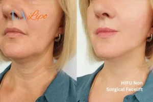 hi-fu for wrinkles Bexley before and after results