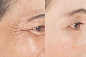 Before and after results of woman - HI-fu wrinkles reduction treatment Bexley