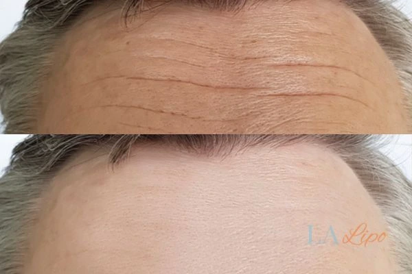 results of HIFU Bexley on mans forehead to help reduce lines and wrinkles