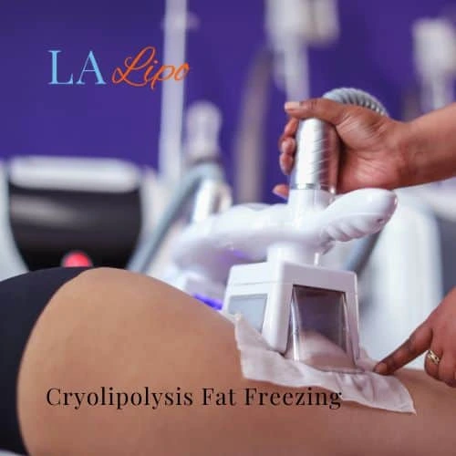 fat freezing - Cryolipolysis Bexley