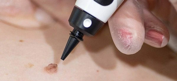 skin tag removal using cryopen Bexley