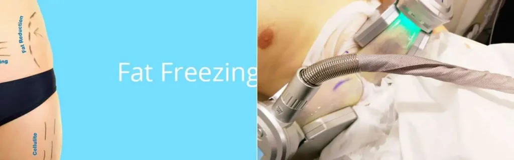 multi areas of a persons body having coolsculpting Bexley treatment