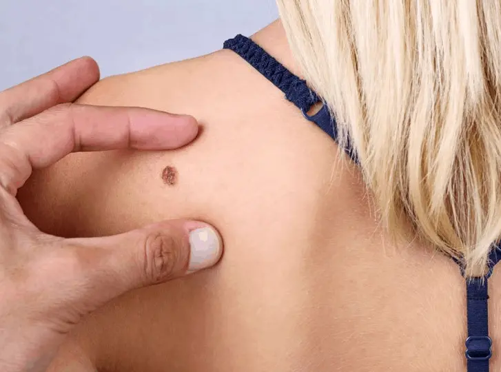 woman having mole removal Bexley consultation before treatment.