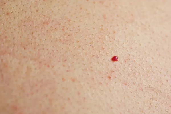 close up of a cherry angioma Bexley
