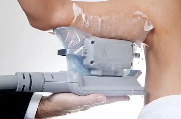 Picture of fat freezing Bexley on the upper arms.