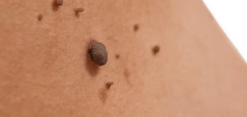 image of a skin tag Bexley