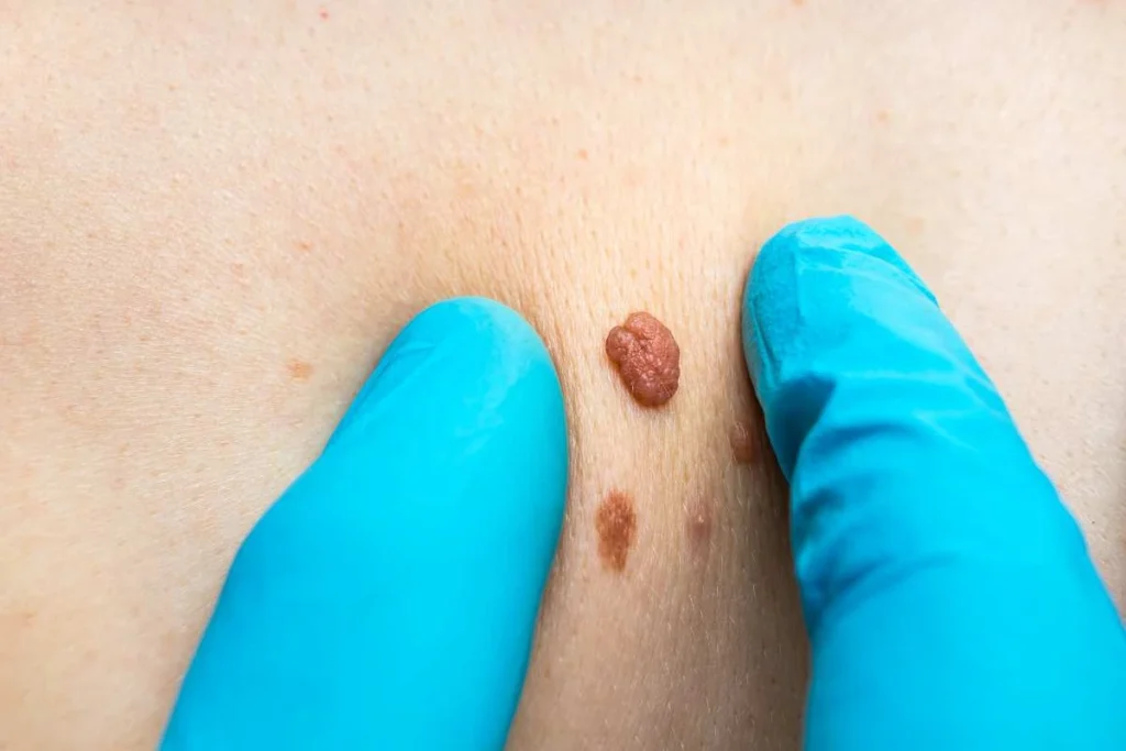 Consultant examining a skin tag Bexley