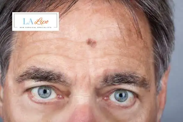 Solar Lentigo Removal Bexley image of man with mark on his forehead