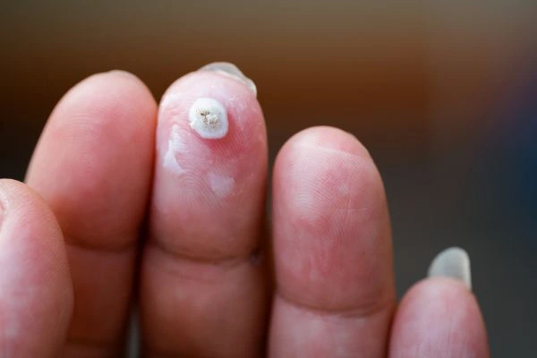 wart on person finger - cryotherapy to treat from LA LIPO Bexley