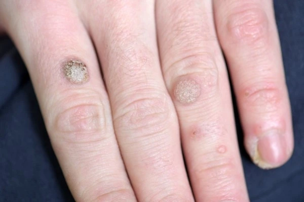 photo of warts on person hand - see wart removal Bexley from LA LIPO