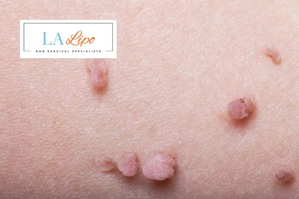 Does cryopen skin tag removal Bexley hurt? Find out now call our team today!