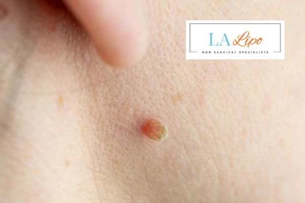Book skin tag removal Bexley today speak to our team now!