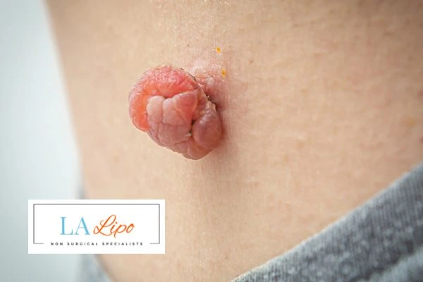 Interested in skin tag removal Bexley? Concerned about the pain? Find out more today!