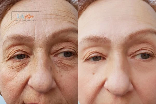 The powerful benefits of Morpheus8 Treatment Bexley - Call Our team today!
