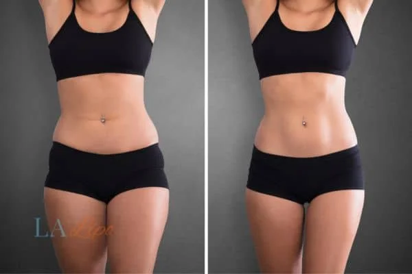 before and after results of non-surgical treatment to help a woman's body image and mental health Bexley