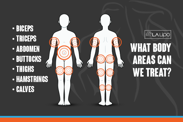 Diagram to show areas you can have LA-EMS Body Sculpting Treatment Bexley