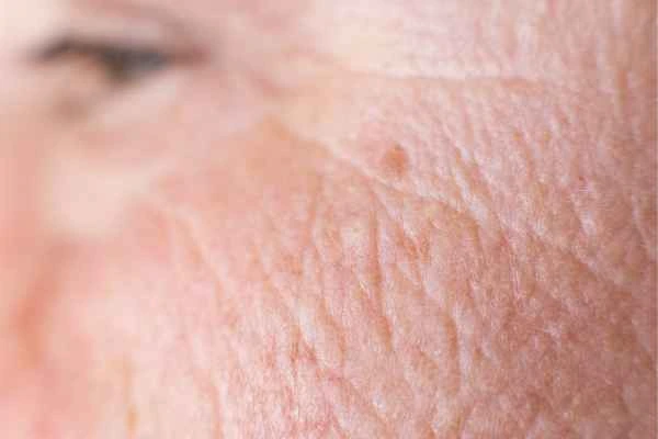 close up picture of a woman's face showing an age spot Bexley