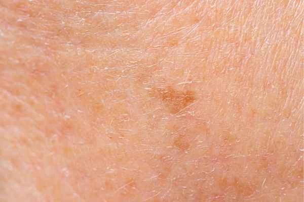 close up picture of age spots Bexley