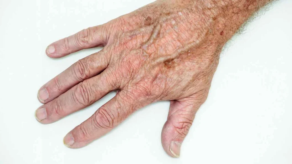 Male hand showing age spot Bexley