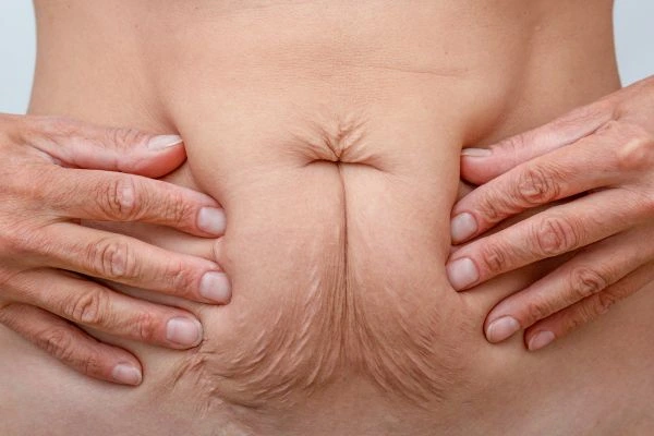 Image of a woman's stomach with loose skin - example of skin tightening Bexley options