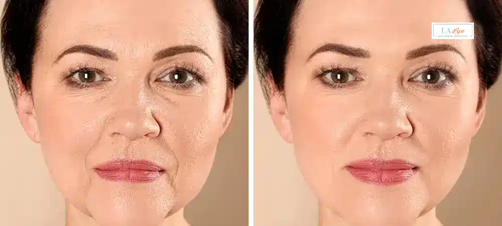 How Long Does It Take to See Results and How Long Do They Last Bexley?