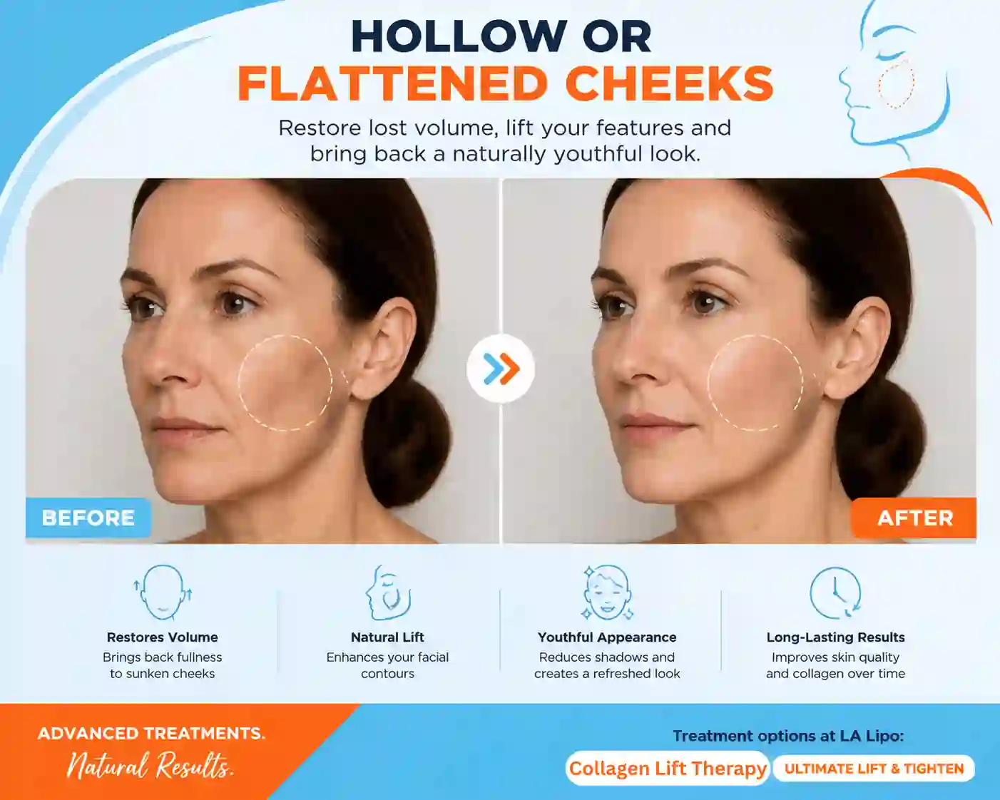 Sign #4: Hollow or Flattened Cheeks Bexley