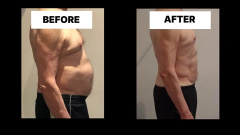What Symptoms Can Diastasis Recti Cause in Men? Weak Core, Back Pain and Poor Posture Bexley